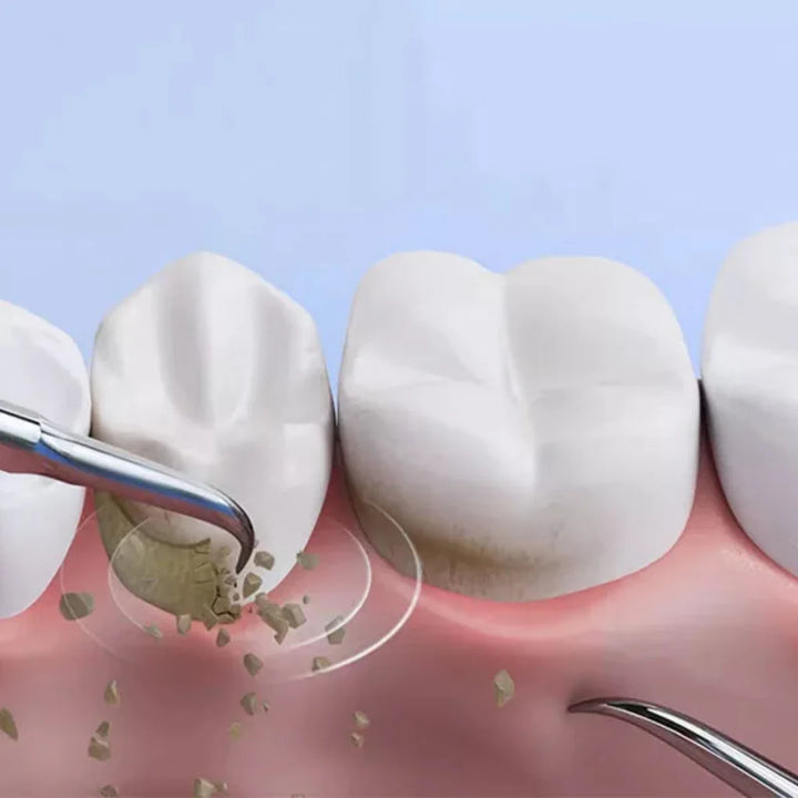 Strumento per la rimozione della placca da tartaro dentale