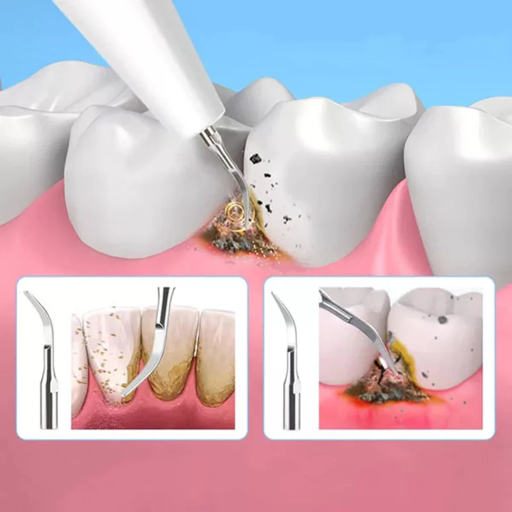 Strumento per la rimozione della placca da tartaro dentale