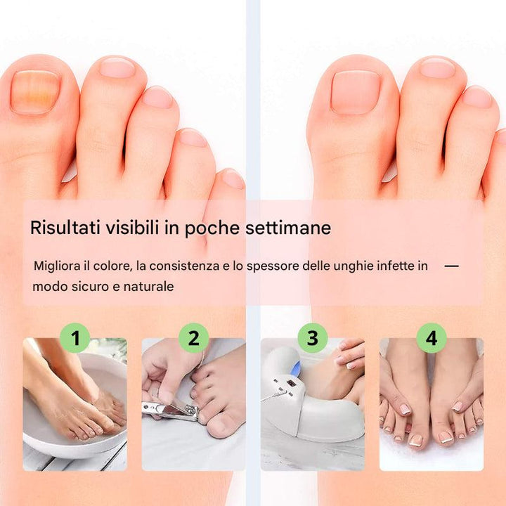 Dispositivo laser per la rimozione dei funghi alle unghie